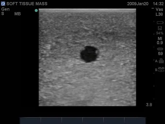 Breast Biopsy Ultrasound Training Model