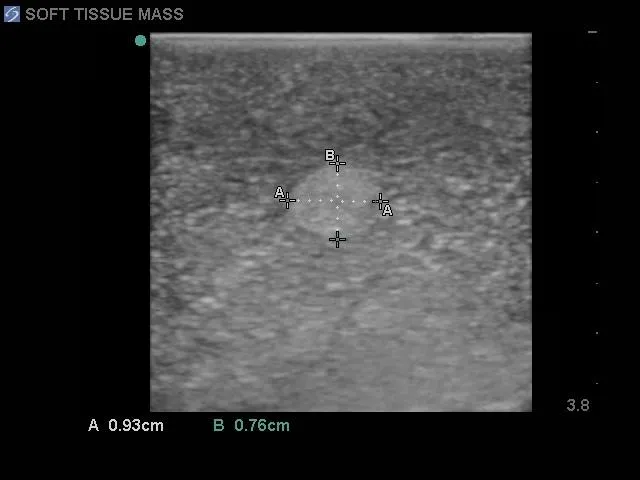 Breast Biopsy Ultrasound Training Model