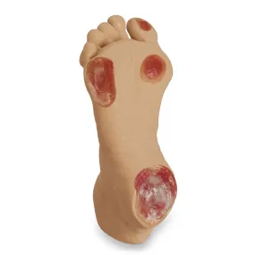 Elderly Pressure Ulcer Foot, Light