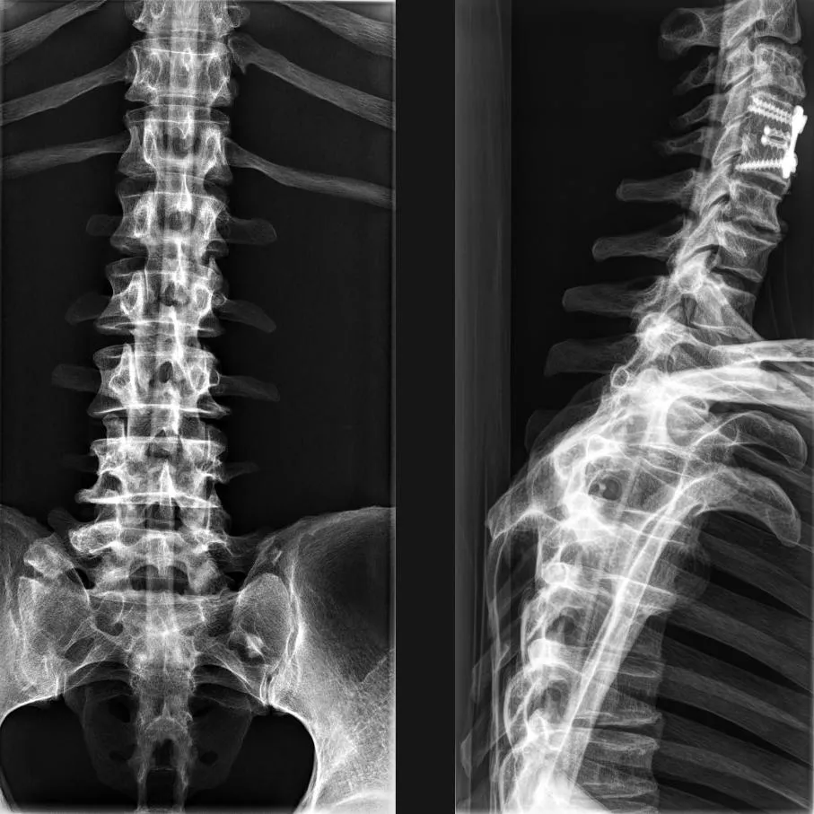 Full Body X-Ray Phantom with Real Human Skeleton Bones