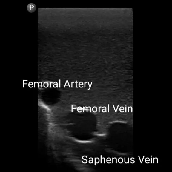 Gen II Femoral Vascular Access and Regional Anesthesia Ultrasound Training Model