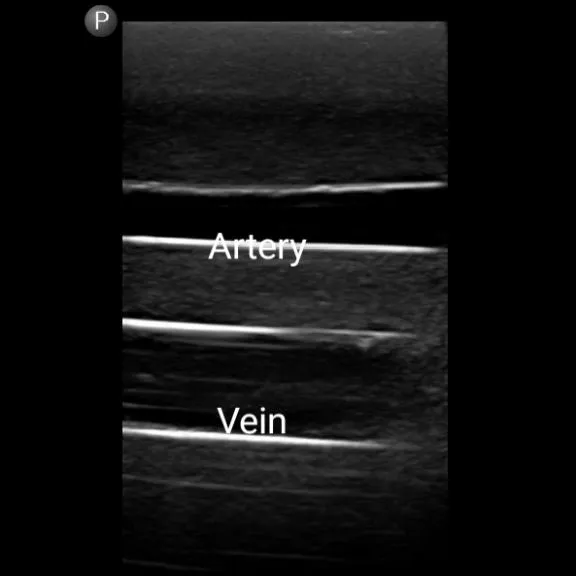 Gen II Femoral Vascular Access and Regional Anesthesia Ultrasound Training Model