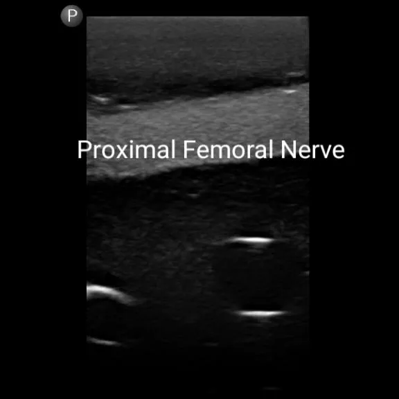 Gen II Femoral Vascular Access and Regional Anesthesia Ultrasound Training Model