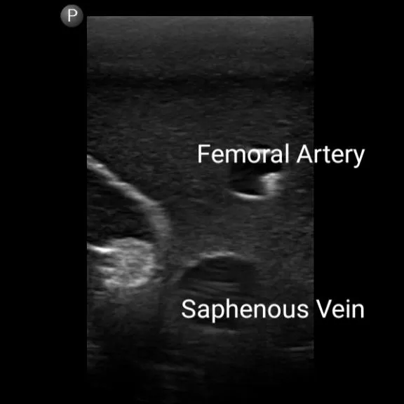 Gen II Femoral Vascular Access and Regional Anesthesia Ultrasound Training Model