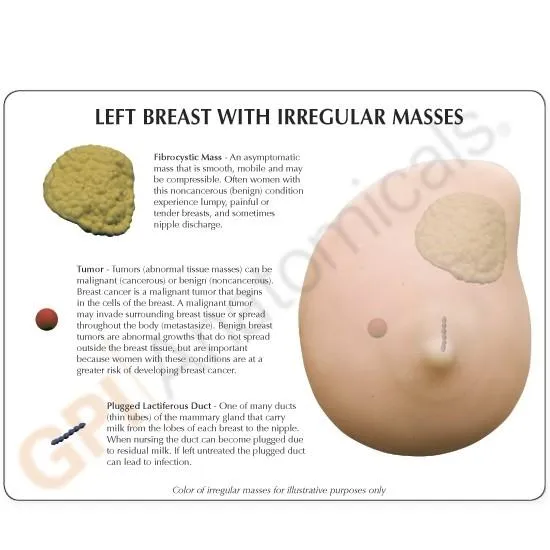 Left Breast Cancer Model, Life-like