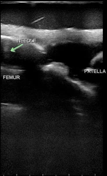 MSK Knee Ultrasound Training Model