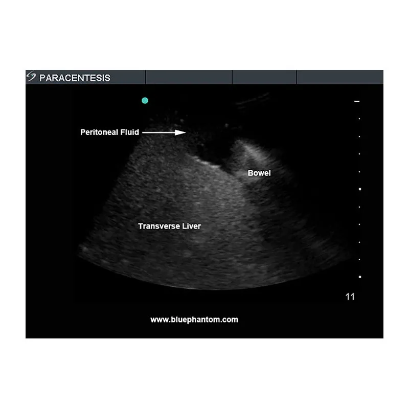 Paracentesis Ultrasound Training Model