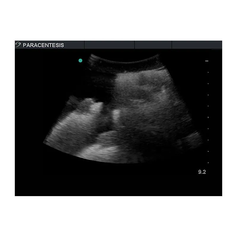 Paracentesis Ultrasound Training Model