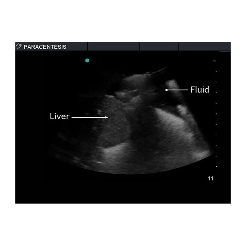 Paracentesis Ultrasound Training Model