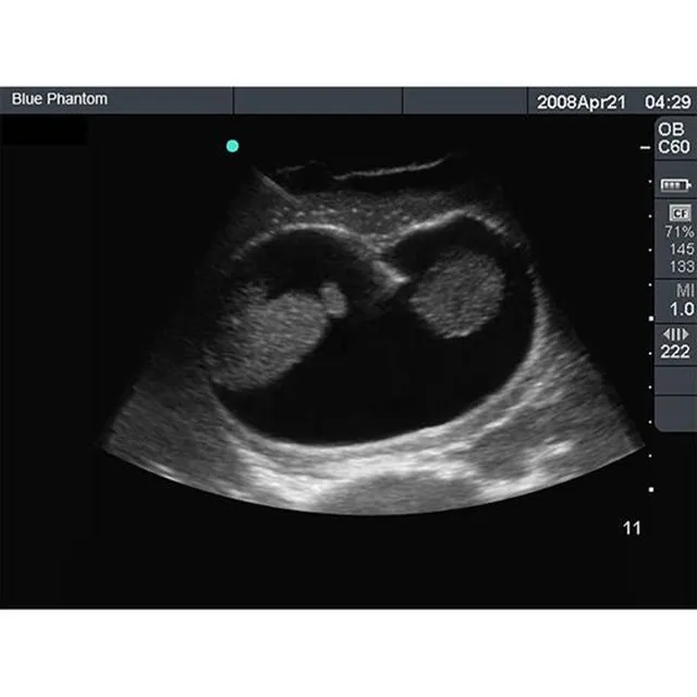 Percutaneous Umbilical Cord Blood Sampling Ultrasound Training Model