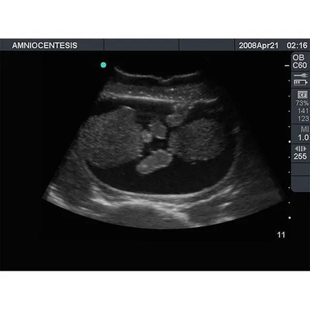 Percutaneous Umbilical Cord Blood Sampling Ultrasound Training Model