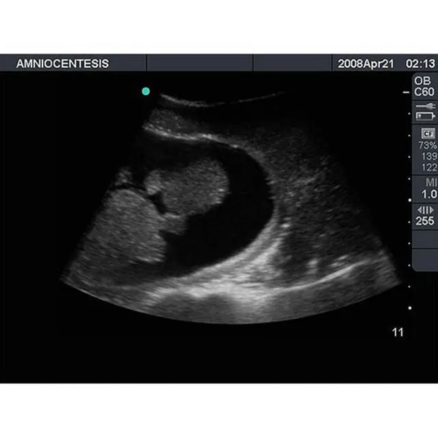 Percutaneous Umbilical Cord Blood Sampling Ultrasound Training Model