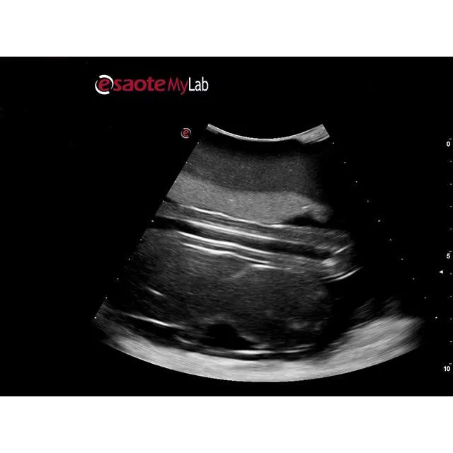 Percutaneous Umbilical Cord Blood Sampling Ultrasound Training Model