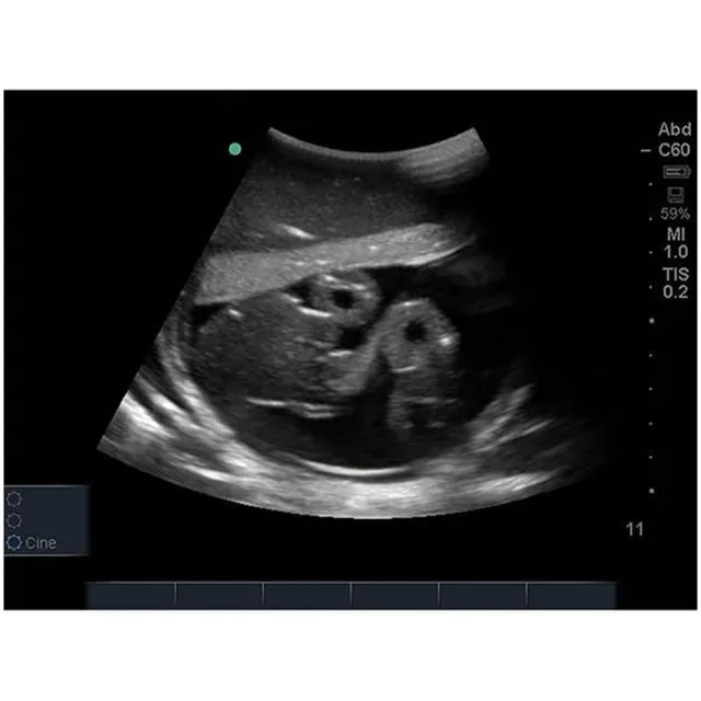 Percutaneous Umbilical Cord Blood Sampling Ultrasound Training Model