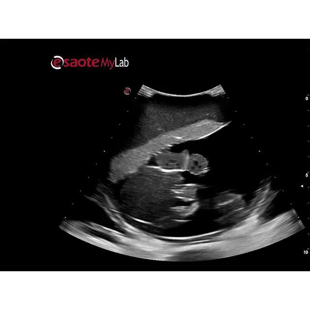 Percutaneous Umbilical Cord Blood Sampling Ultrasound Training Model