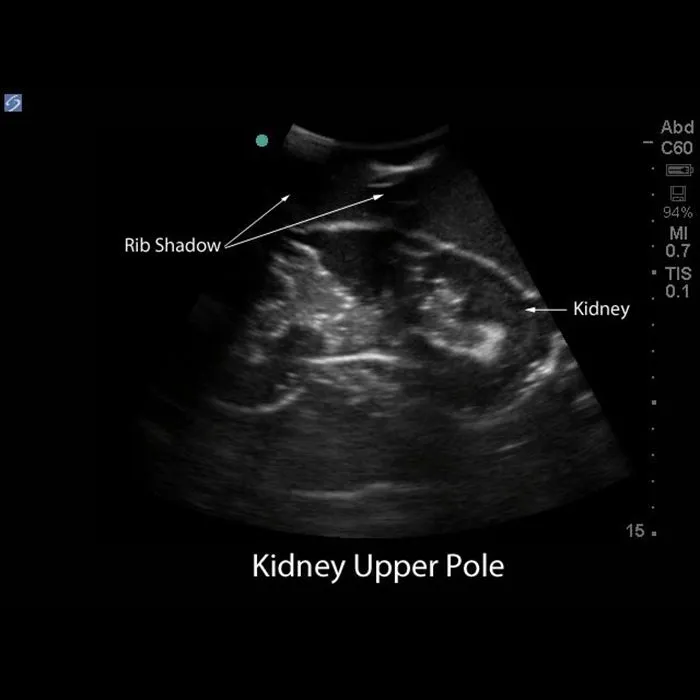 Renal Biopsy Ultrasound Training Model