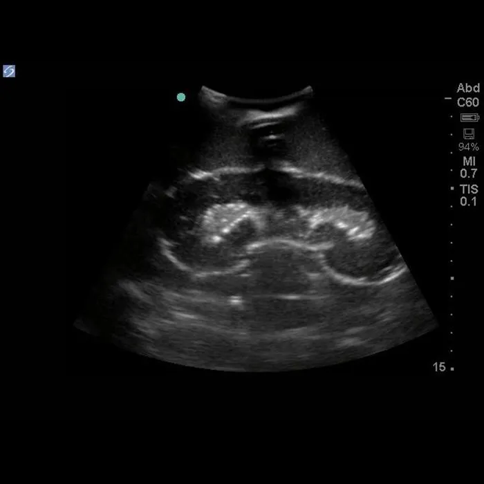 Renal Biopsy Ultrasound Training Model