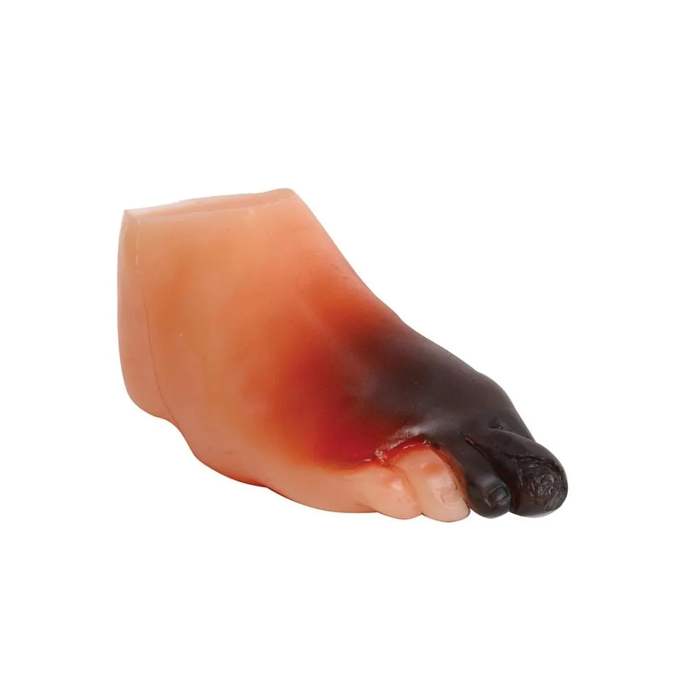 Severe Diabetic Foot Model