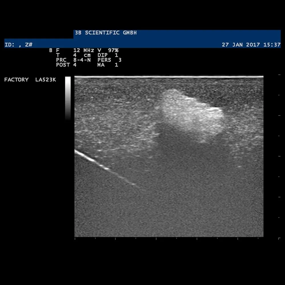 SONOtrain™ Breast with tumors