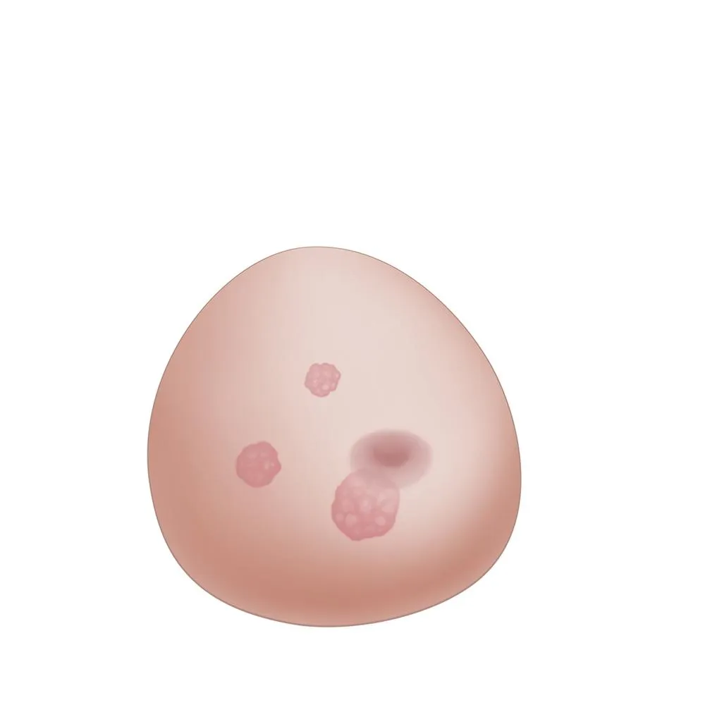 SONOtrain™ Breast with tumors
