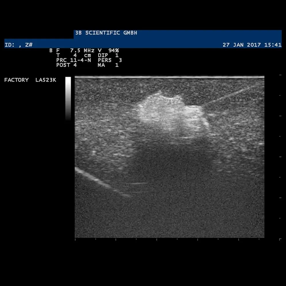 SONOtrain™ Breast with tumors