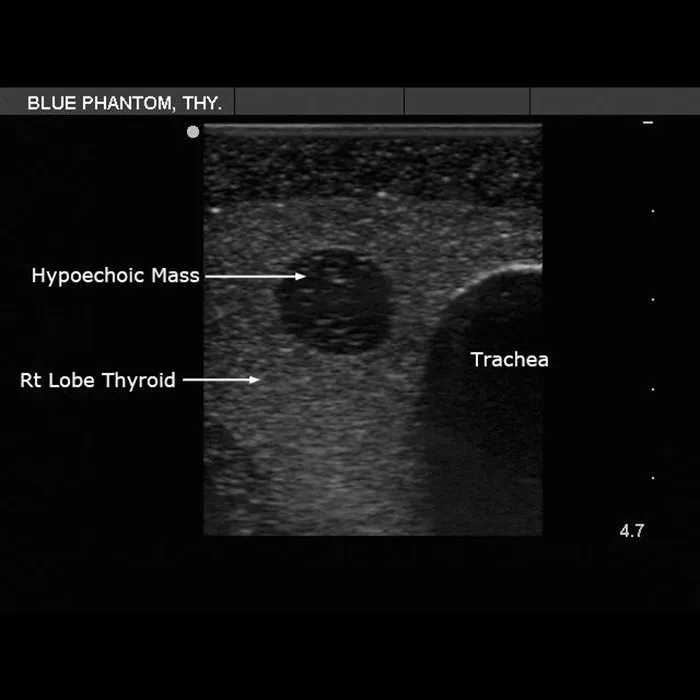 Thyroid Biopsy Ultrasound Training Model