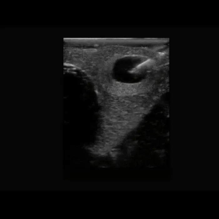Thyroid Biopsy Ultrasound Training Model