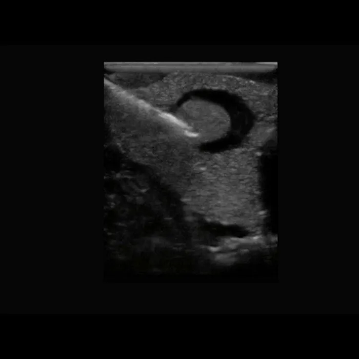 Thyroid Biopsy Ultrasound Training Model