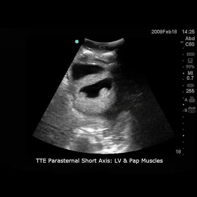 Transthoracic Echocardiography and Pericardiocentesis Ultrasound Training Model