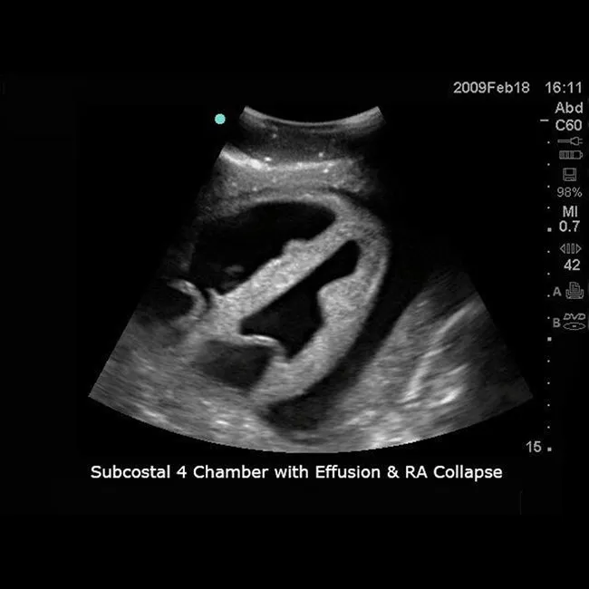 Transthoracic Echocardiography and Pericardiocentesis Ultrasound Training Model