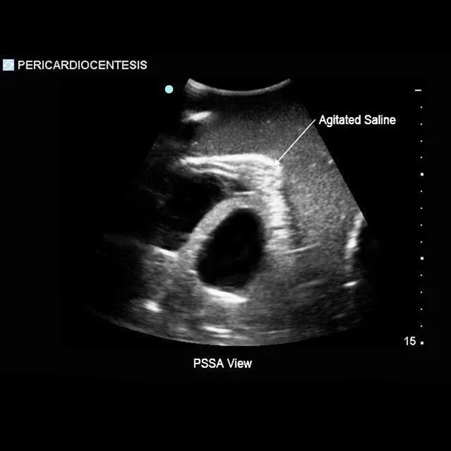 Transthoracic Echocardiography and Pericardiocentesis Ultrasound Training Model