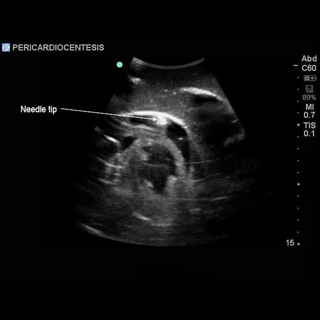 Transthoracic Echocardiography and Pericardiocentesis Ultrasound Training Model