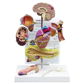 Type II Diabetes Set Model